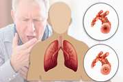 تشدید علائم COPD با مصرف داروی گاباپنتین