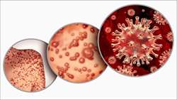 استفاده از داروی Tecovirimat  در درمان آبله میمونی (Mpox)