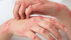  اگزما (درماتیت آتوپیک)