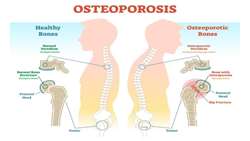 یک داروی جدید برای پوکی استخوان: Romosozumab