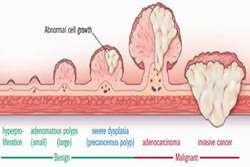  پولیپ‌های دستگاه گوارش