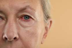 بلفاریت چشمی