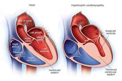 معرفی یک داروی جدید: Mavacamten