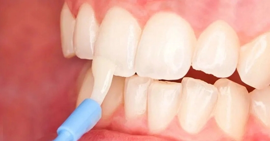 Fluoride-Varnish 