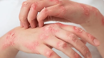  اگزما (درماتیت آتوپیک)