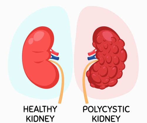  کلیه پلی‌کیستیک